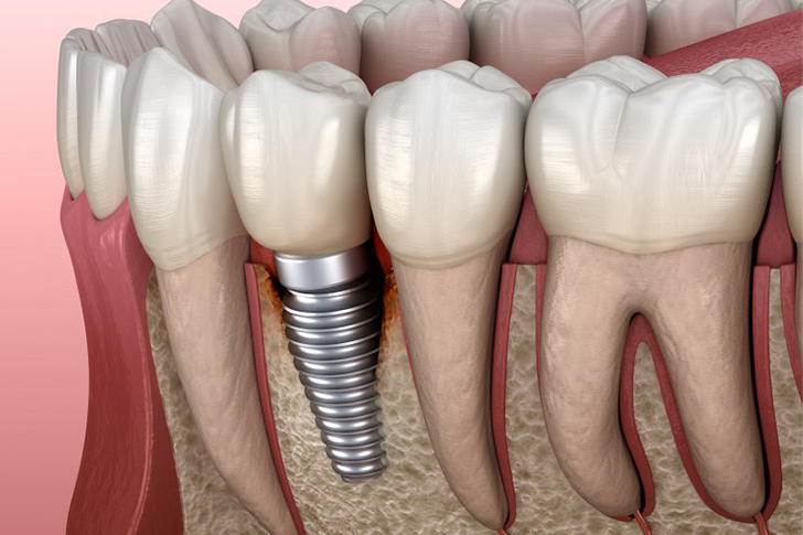 Unlock Your Smile: The Ultimate Guide to Affordable & Low-Cost Dental Implants for Seniors