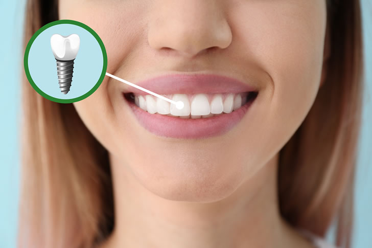 Navigating Titanium vs. Zirconia Dental Implants